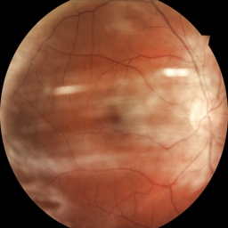 Distorted healthy eye image